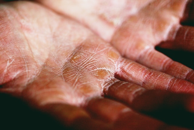hands with eczema