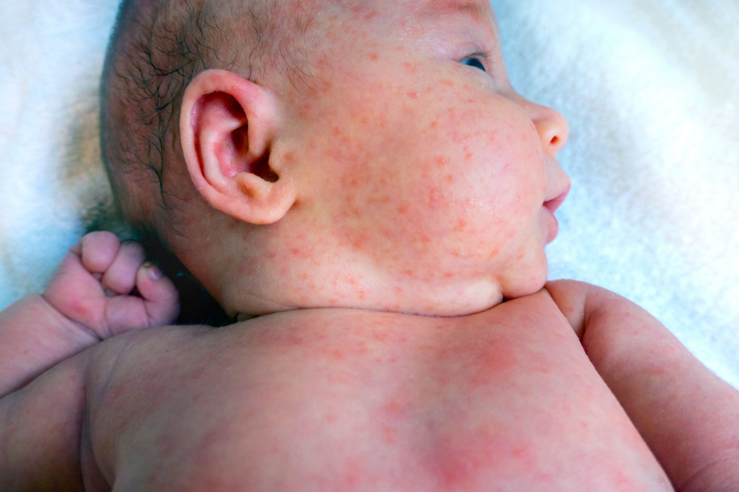 Close-up of an infant with mild skin irritation.